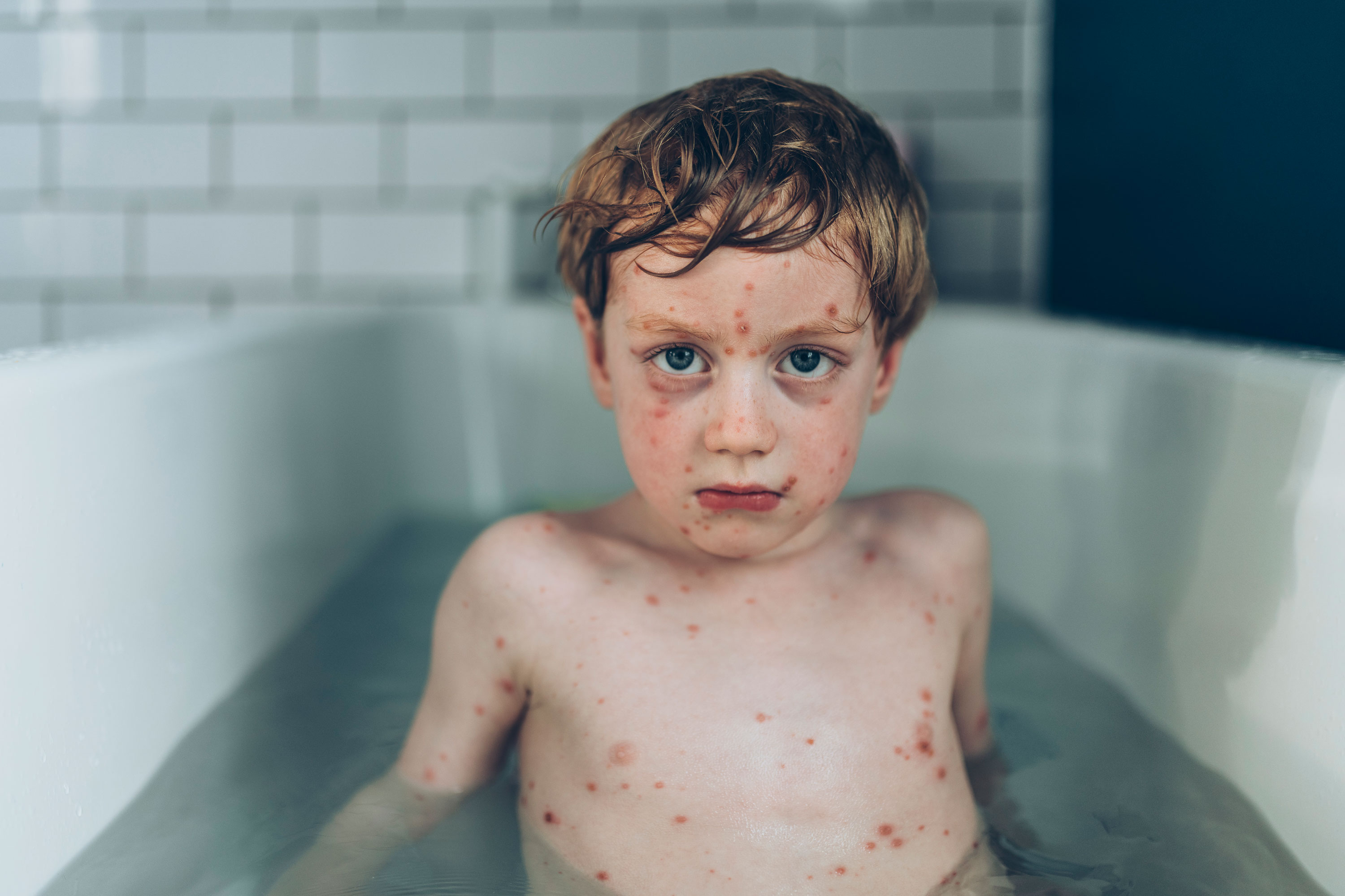 A young boy with chickenpox sits in the bath