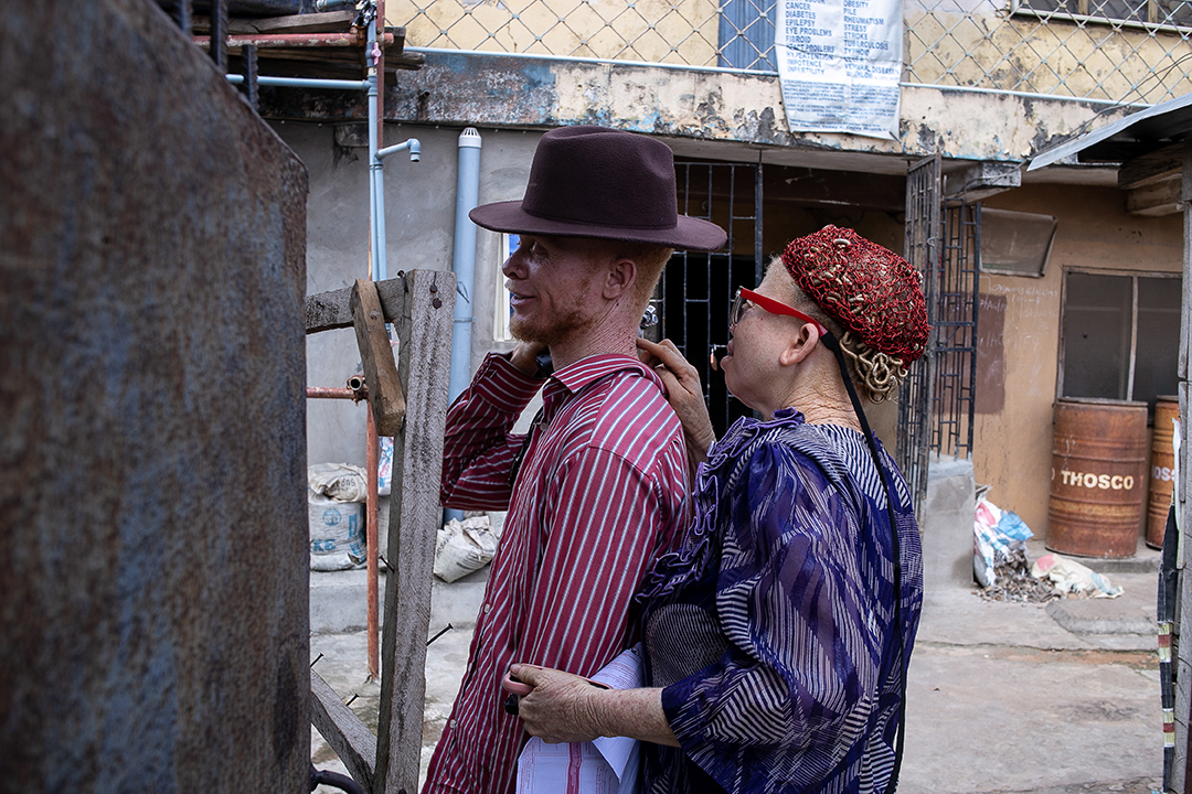 A man and a woman, both with albinism, greet each other.