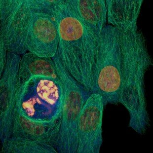 Breast cancer cells with one dying