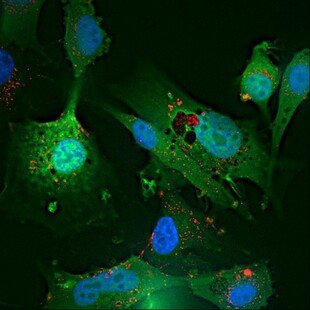 Glioblastoma cells showing endocytosis