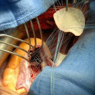 Repair of ventricular septal defect