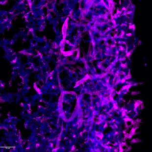 Rhizopus invasion of lung tissue.