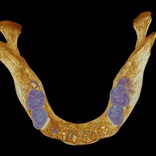 One of the winning images for the 2014 Wellcome Image Awards. Micro-computed tomography scan of a medieval human lower jawbone by Kevin Mackenzie.