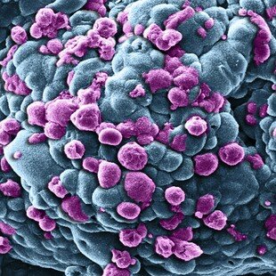 One of the winning images for the 2014 Wellcome Image Awards. Scanning electron micrograph of a cluster of breast cancer cells by Khuloud T Al-Jamal and Izzat Suffian.