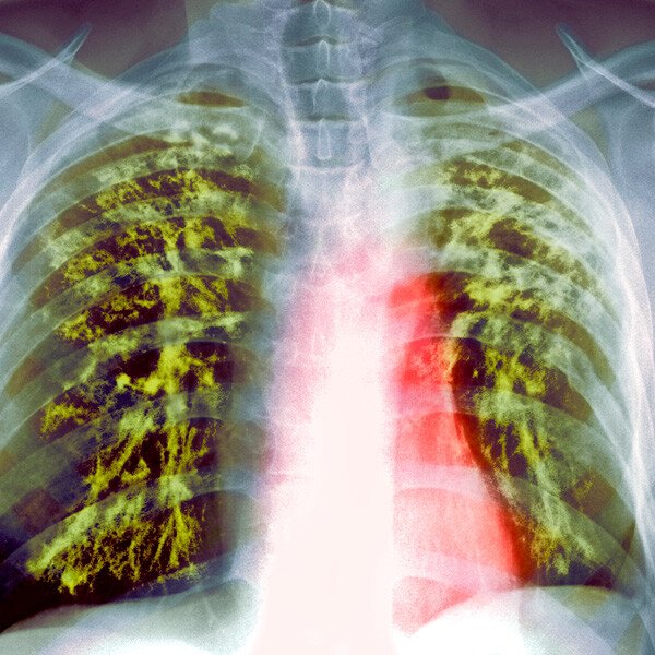 Breakthrough in battle against resistant TB