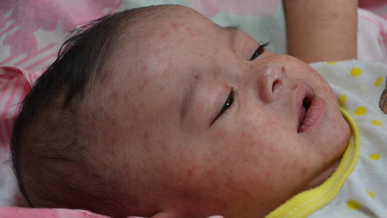A baby in hospital with measles in the Philippines